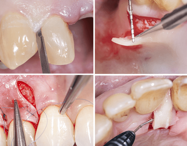 The Link Between Periodontics And Implant Success