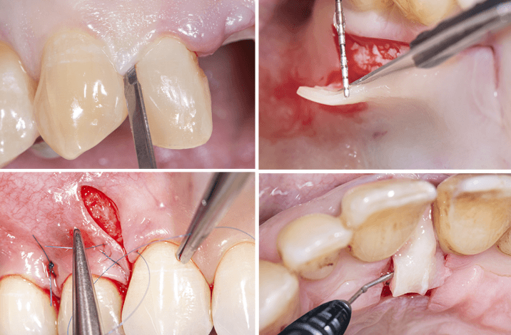 The Link Between Periodontics And Implant Success