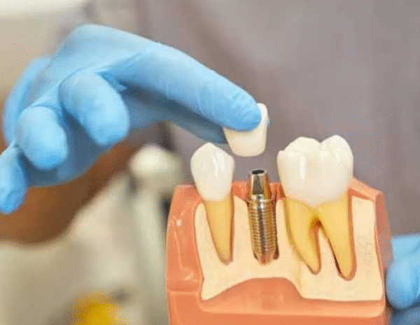 5 Misconceptions Patients Have About Dental Implant Surgery