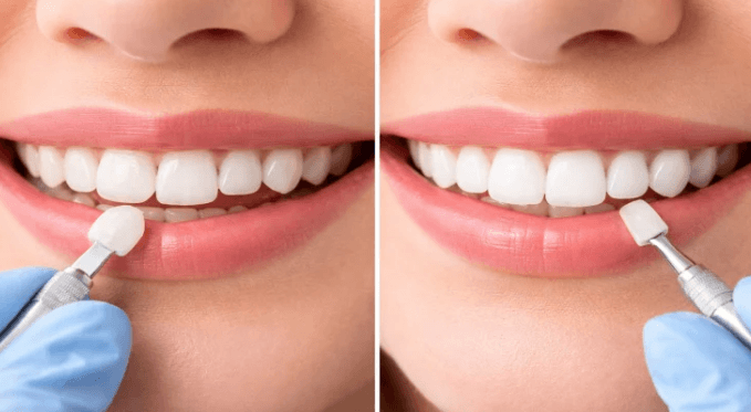 How Dentists Blend Crowns, Bonding, And Whitening Into One Plan