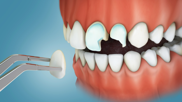 How Preventive Dental Care Extends The Life Of Crowns, Bonding, And Veneers